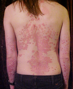 Psoriasis_on_back