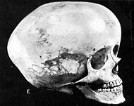 190px-Hydrocephalic_skull