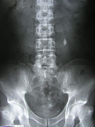 Рентгенограмма, демонстрирующая конкремент в левом мочеточнике