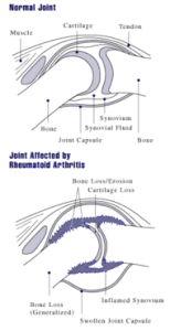 190px-Rheumatoid_arthritis_joint