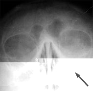 Рентгеновский снимок пазух больного гайморитом (стрелкой обозначено затемнение в области верхнечелюстной пазухи, указывающее на присутствие в ней жидкости)