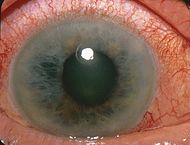 190px-Acute_Angle_Closure-glaucoma
