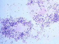 Колонии Gardnerella vaginalis во влагалищном мазке, под микроскопом.