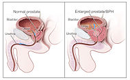 Нормальная (слева) и патологически увеличенная (справа) предстательная железа