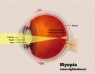 190px-Myopia