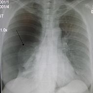 Правосторонний спонтанный пневмоторакс (слева на изображении). Стрелкой указан край спавшегося лёгкого.