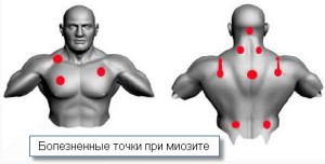 Миозит-мышц-грудной-клетки-болезненные-точки